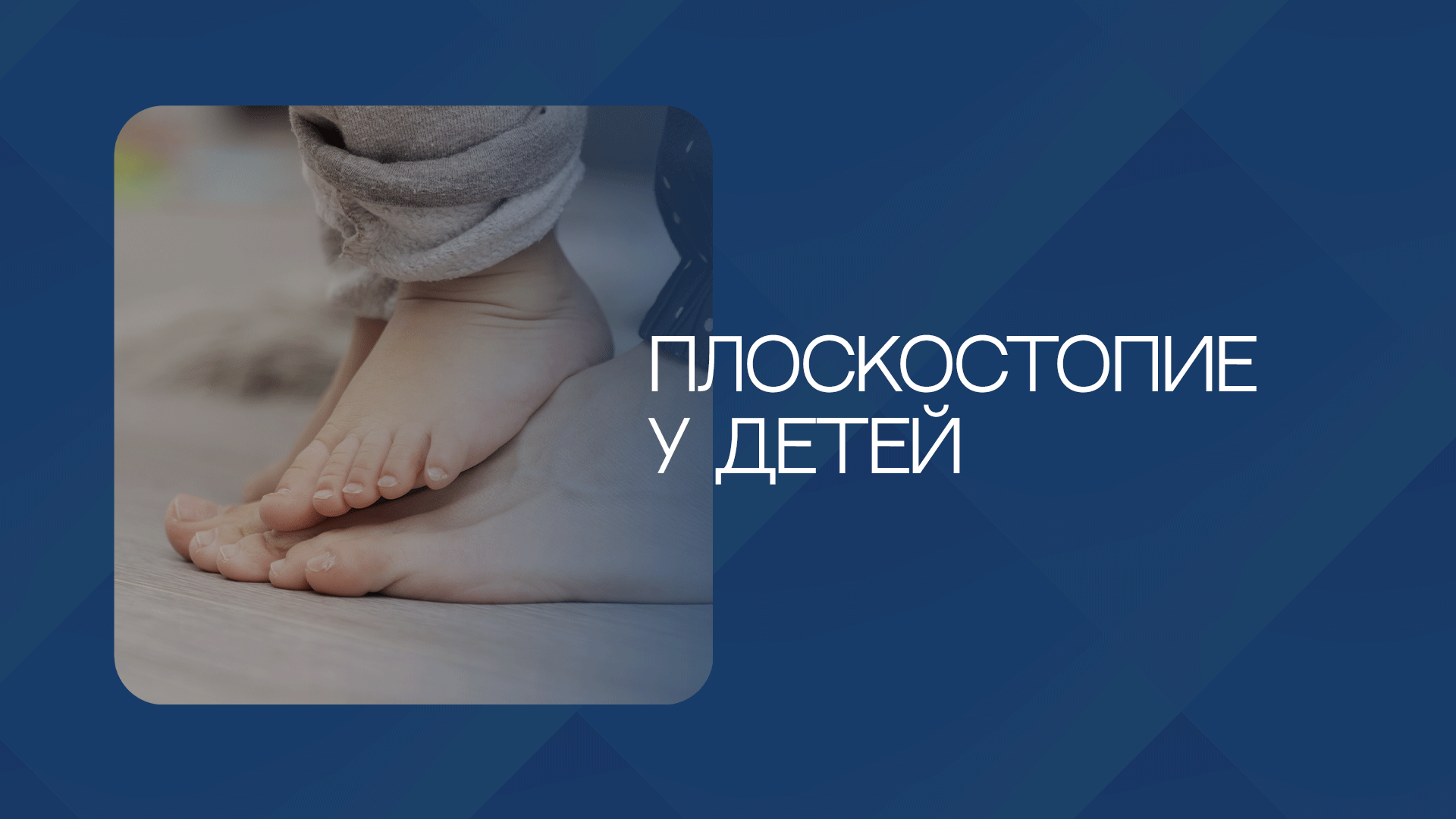 Плоскостопие у детей: как вовремя распознать и что делать?